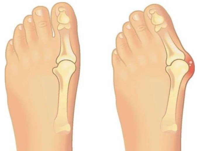 北京圣嘉新美容整形医院大脚骨手术价格