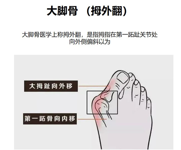 北京圣嘉新拇外翻手术价格