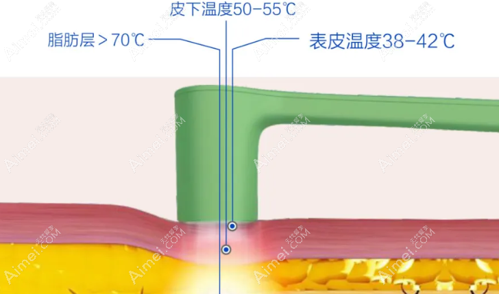 双下巴体雕 双下巴体雕