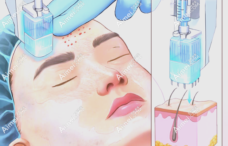 水光治疗 水光治疗