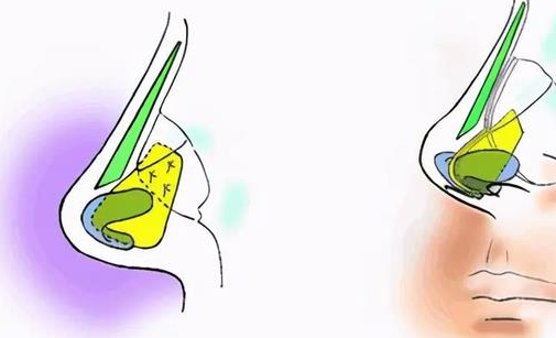 米蘭柏羽陳倩隆鼻價(jià)格是多少？半肋骨隆鼻3.8萬起，含術(shù)后成效反饋