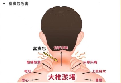 黄学锋消除富贵包是真的