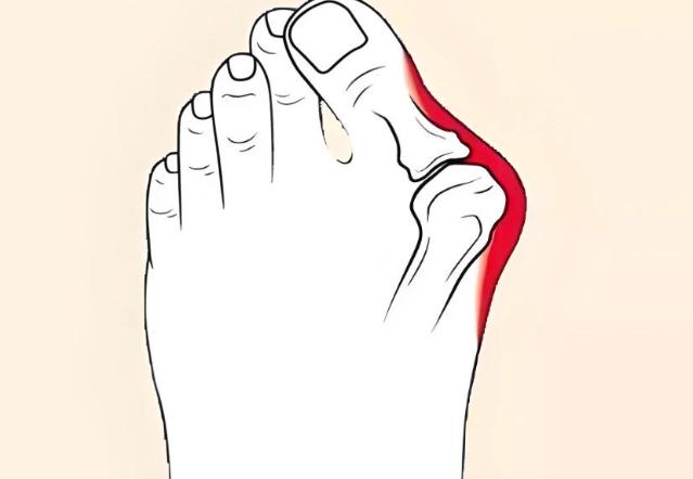 拇外翻手术3d模拟