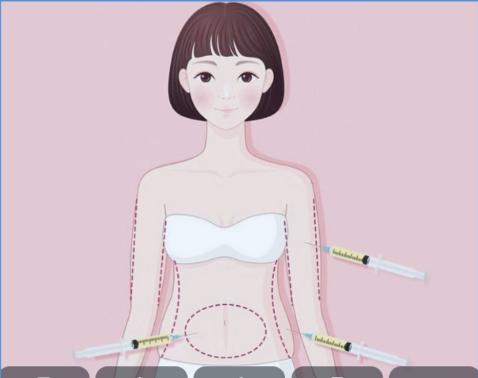 深圳市手臂吸脂