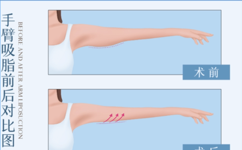 深圳市手臂吸脂