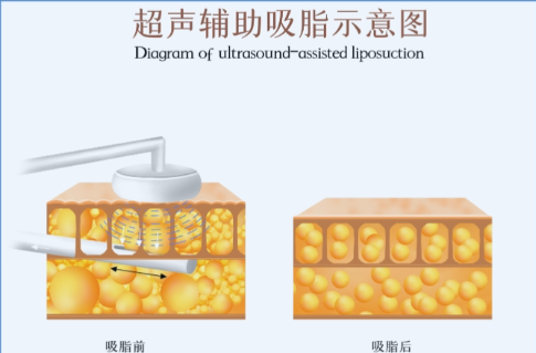 深圳市手臂吸脂