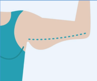 深圳市手臂吸脂