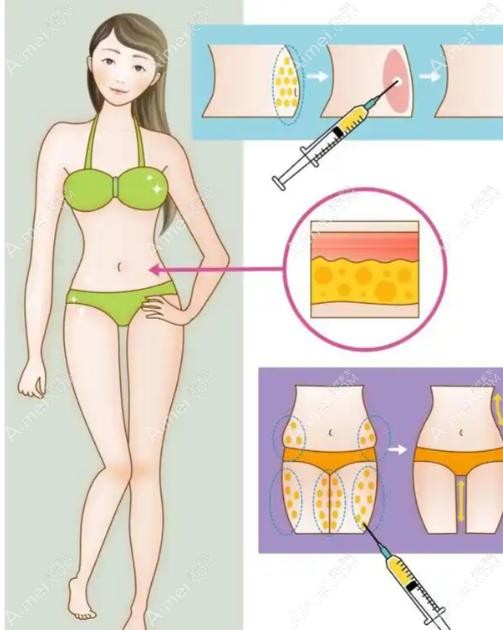 北京八大处吸脂填充