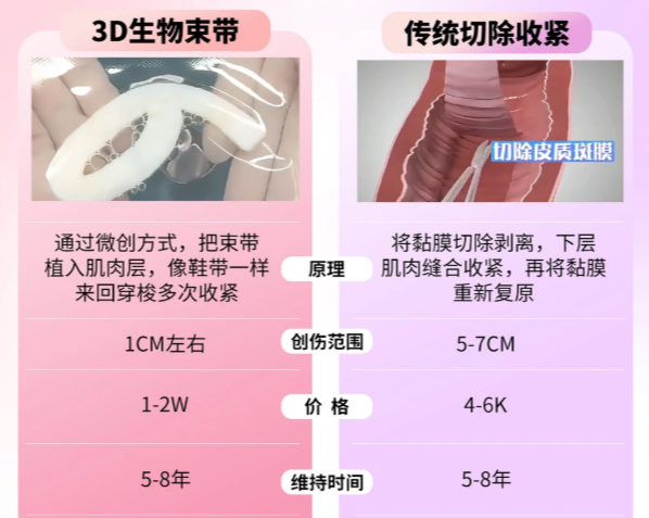 深圳鹏程医院3D生物束带疗效如何？真实实例+术后变好周期解析