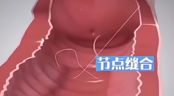 深圳鹏程医院3D生物束带疗效如何