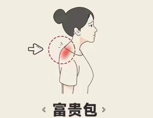 李德明治疗富贵包怎么样