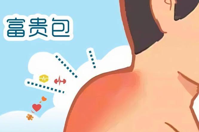 李德明治疗富贵包哪些情况他不建议调理