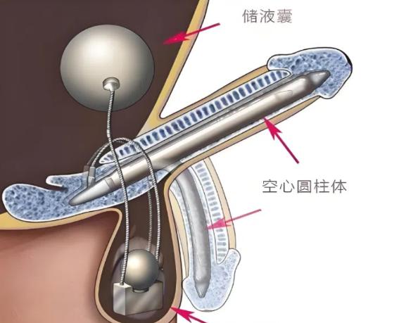 程开祥自体脂肪手术