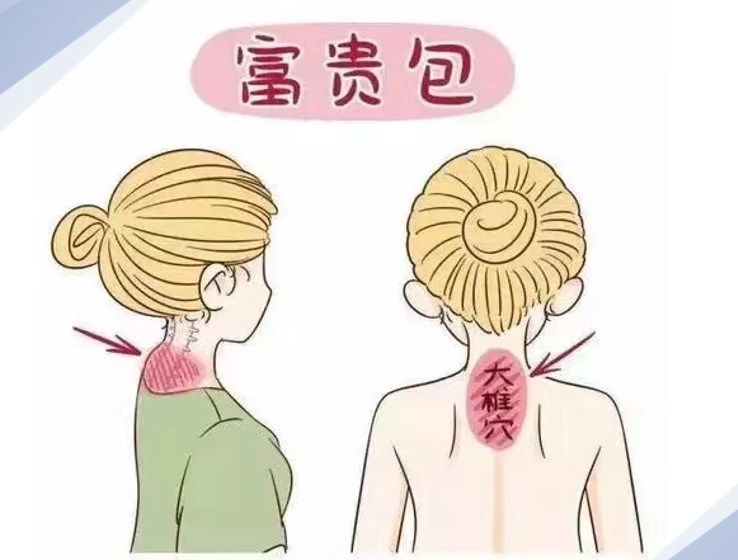 成都友誼醫(yī)院治療富貴包的技術(shù)優(yōu)勢是什么