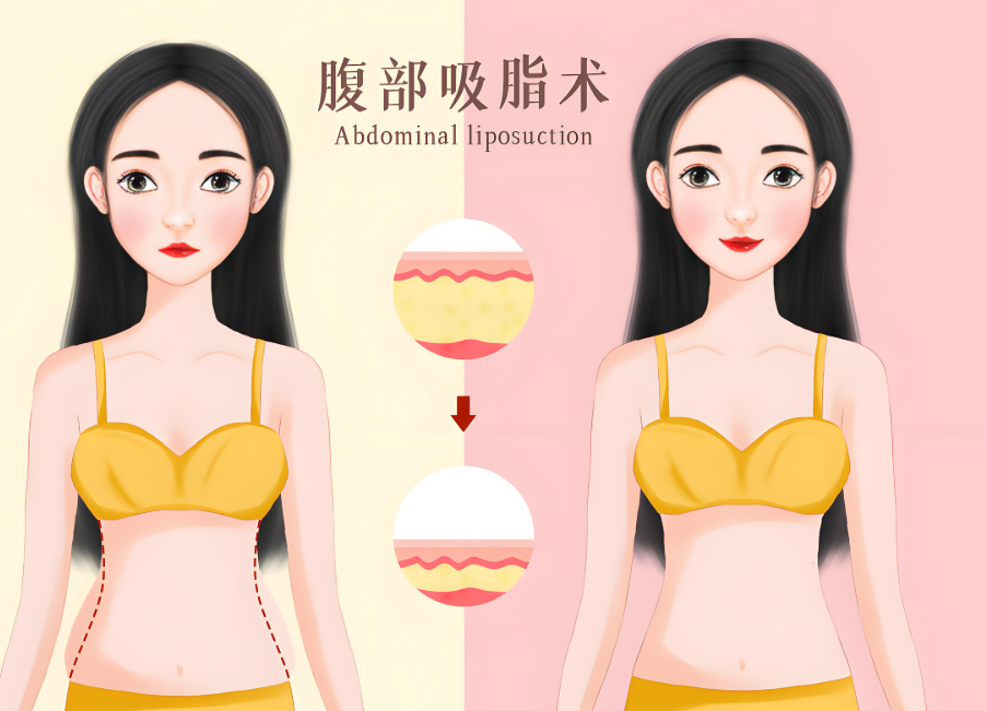 北京艺美医疗美容诊所做吸脂多少钱