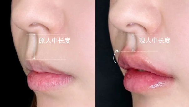 范开防人中手术的术后护理指导