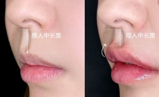 范开防医生人中手术的就诊体验和患者真实分享