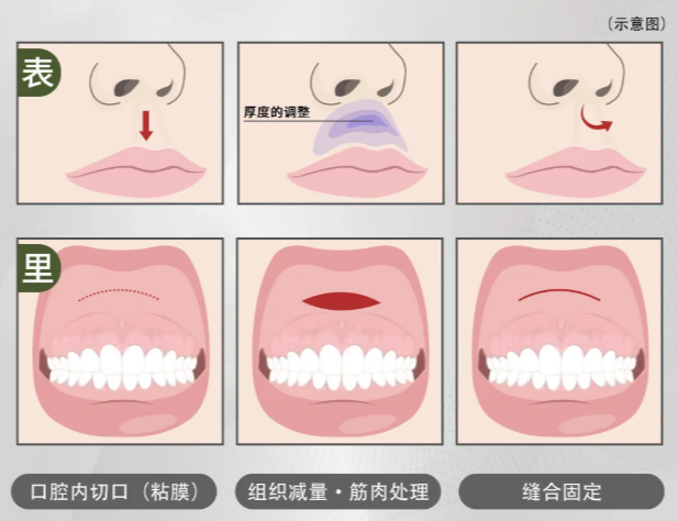 范开防医生人中手术