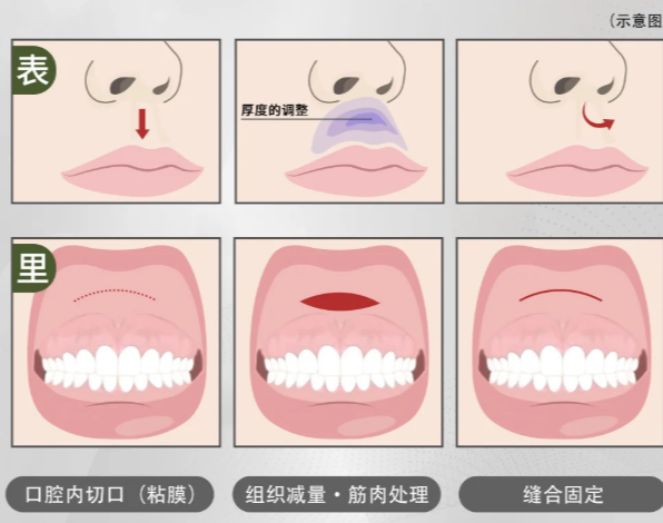 范开防人中手术费用