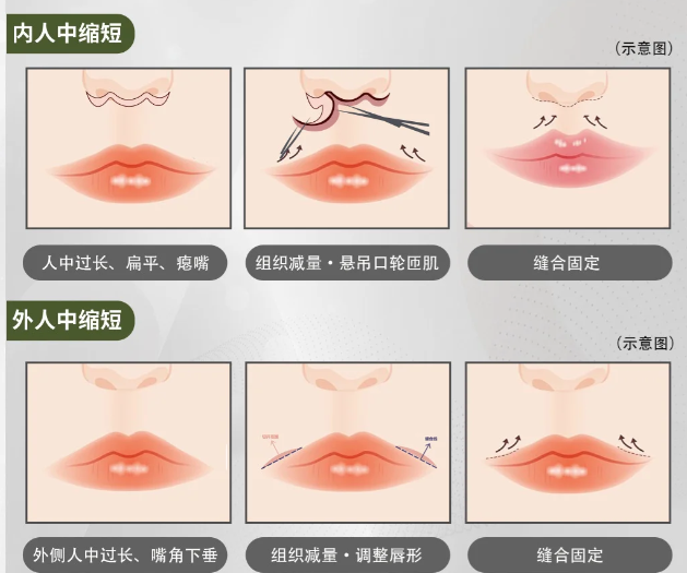 范开防的人中手术后变好指南：做好这5件事，3个月就能自然变好看