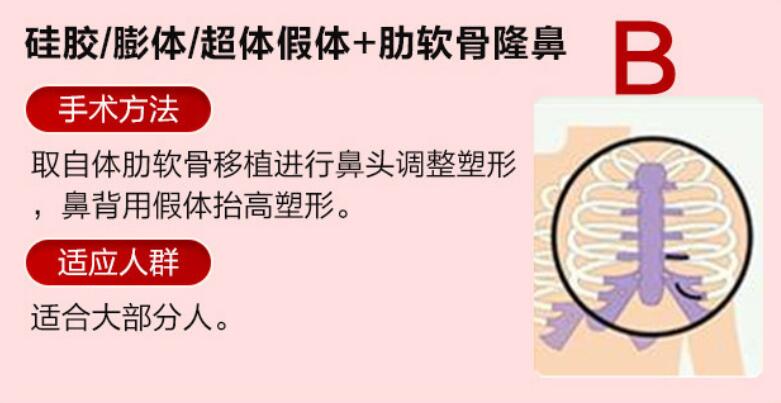 二、深圳非凡整形梅够明医生做鼻子4个新鲜滚热的真人实例反馈全公开