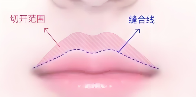 范开防医生人中手术口碑和评价如何？怕留疤的姐妹求真实反馈