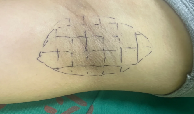 西宁腋臭微创手术医院排名排名2：美莱整形——连锁品牌的“设备+服务”双优势