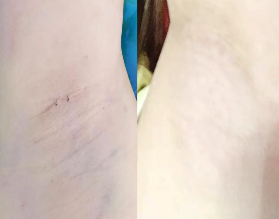 西宁腋臭微创手术医院排名排名5：时光整形——“快变好”的上班族优选