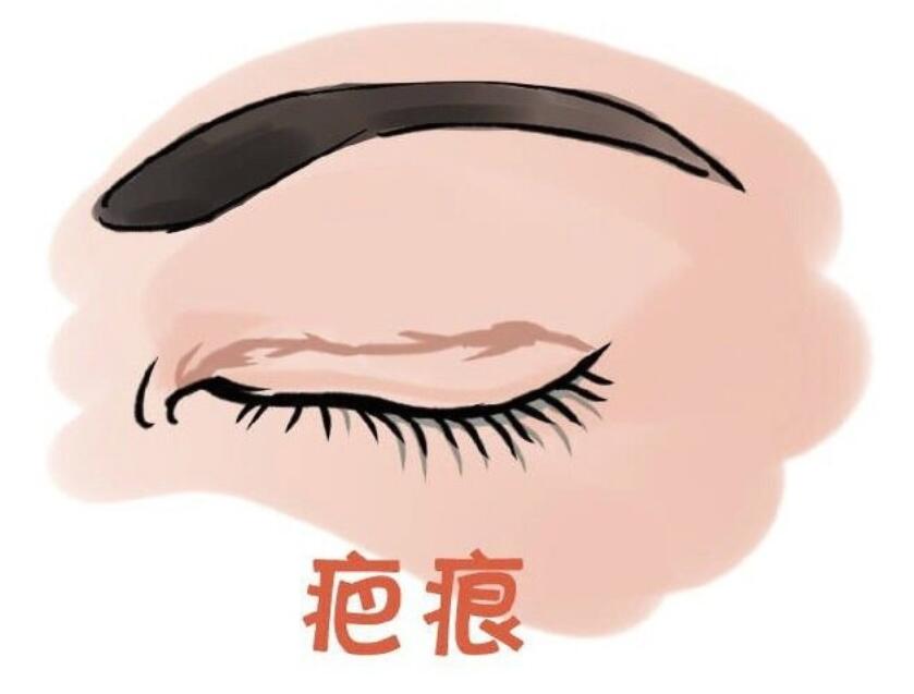 陈运生双眼皮修复的技术特点：为什么能做到自然无痕