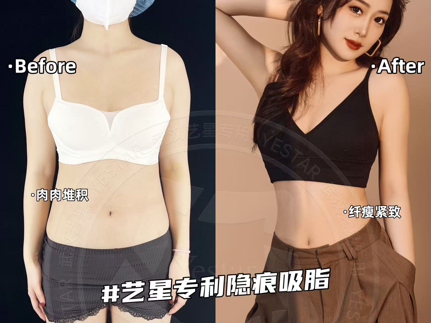 重庆胸部吸脂手术多少钱一次？军科/星荣/华美3家热门医院收费实报不坑人