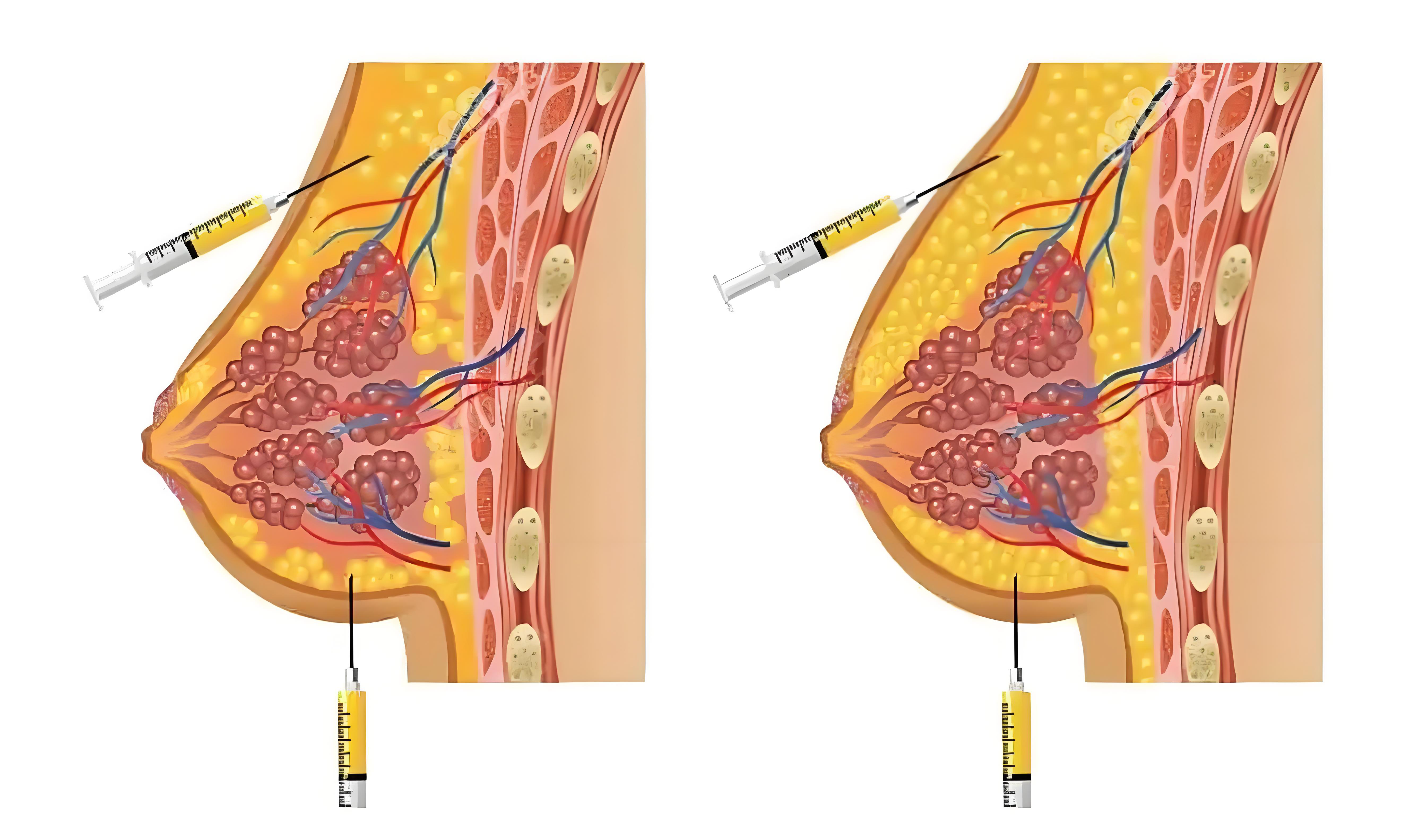 韩啸丰胸手术前后对比会假硬吗？不会，差异在形态更挺，附5个用户亲测的术后触感细节