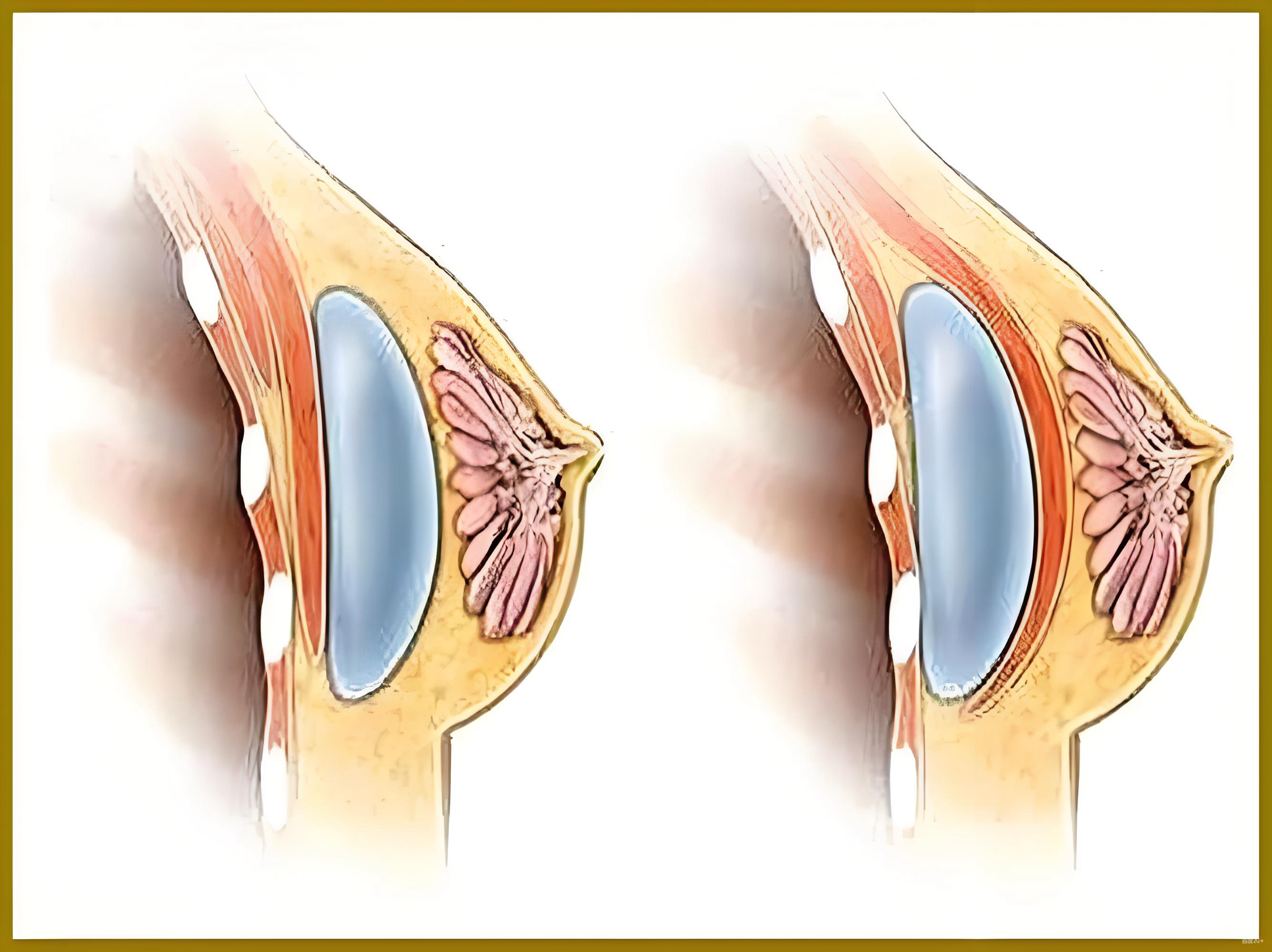 韩啸丰胸手术前后对比差异明显吗