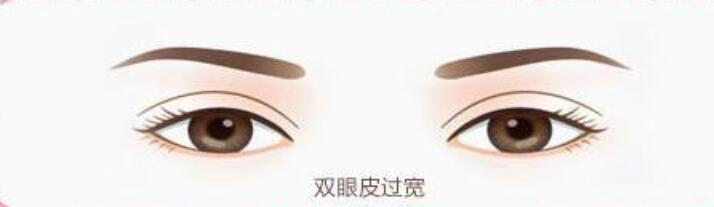 武汉美莱做双眼皮修复的价格