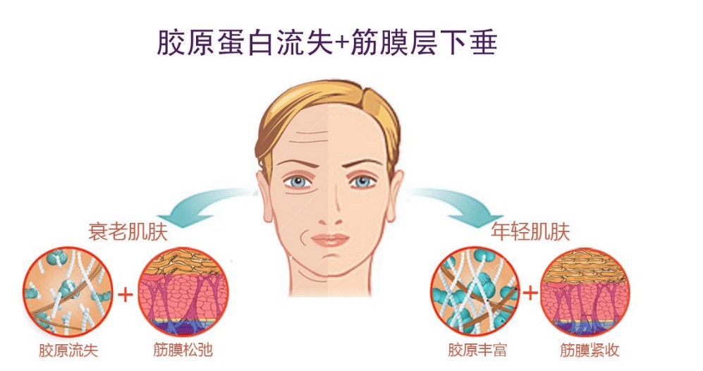 孙玮骏速拉美靠谱吗?真不是智商税!对比传统提升术是深层筋膜复位,技术口碑没翻车