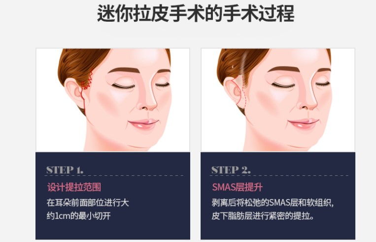上海SMAS筋膜提升三大前医院技术对比