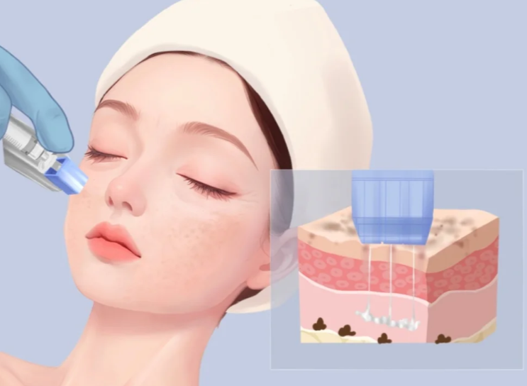 re2o胶原水光的主要功效体现在哪些方面