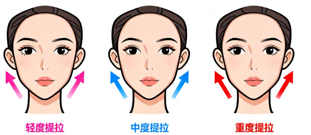 北京四季青橙杨俊医生拉皮实例