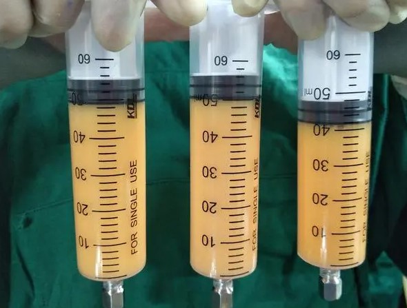 重庆唐国强做吸脂优势