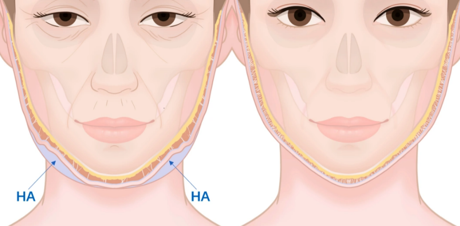 直接排!北京馒化脸修复医院排名哪家强?俊泰美好/纯脂/艺美/奥尔贝德技术TOP4