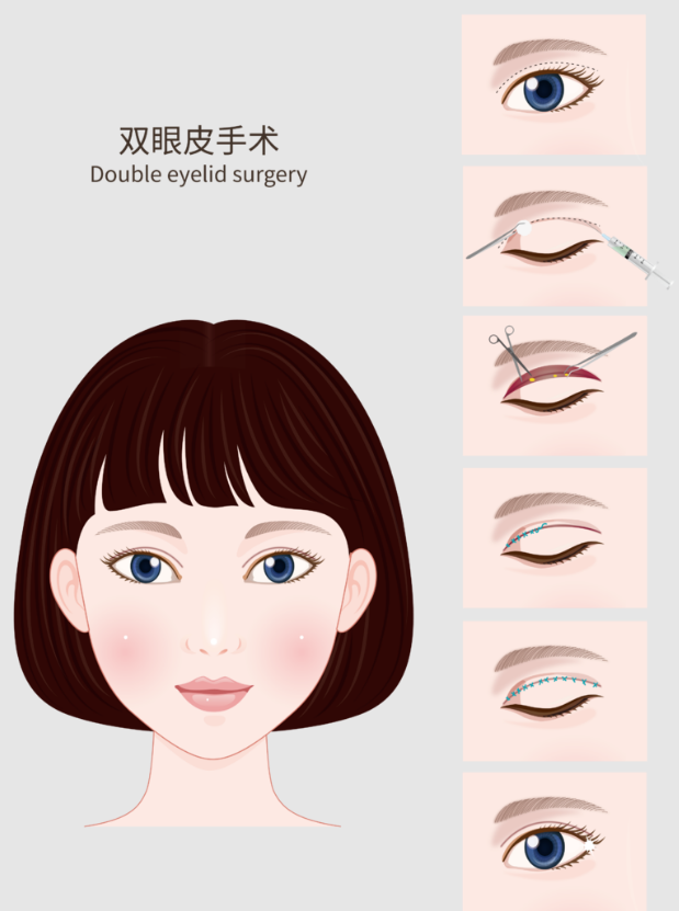北京李燕双眼皮修复医院地址