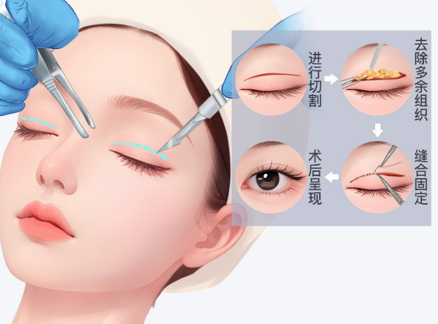 北京李燕双眼皮修复怎么样