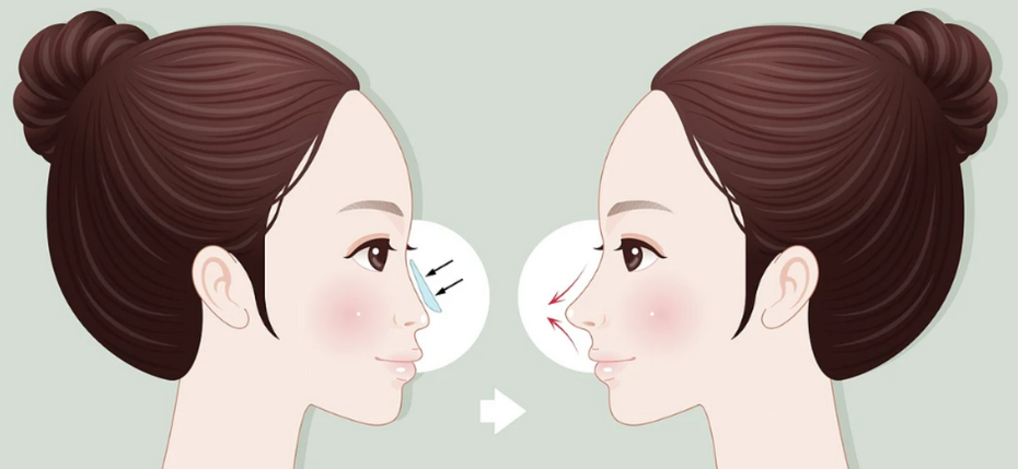 成都刘祎医生修复为什么成功概率高?刘祎双眼皮隆鼻低返修3大秘诀+真实实例拆解!