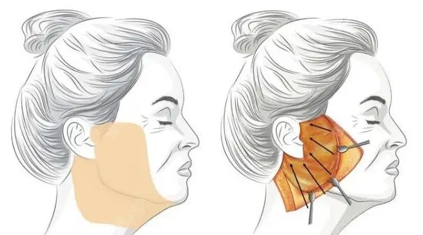 曝光!北京高亚东拉皮价格表:双平面小拉皮5.5万起,全脸拉皮9.8万起,拉皮失败修复15万起