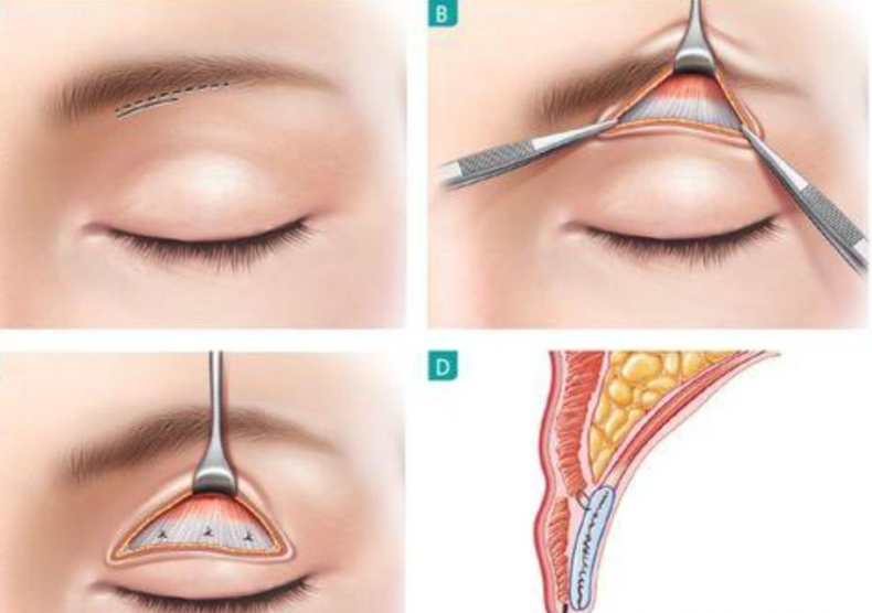 卢玲双眼皮提肌修复技术好