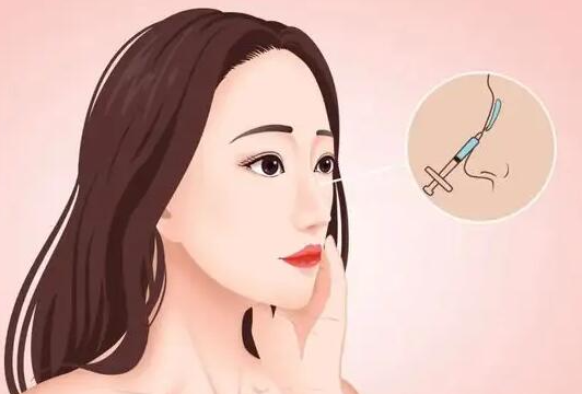 骨雕隆鼻更久但濡白天使不易透光更稳