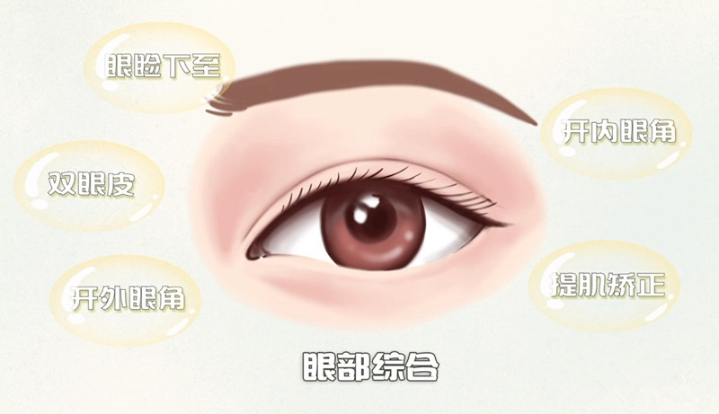 李秋月双眼皮修复的技术特点与实例表现