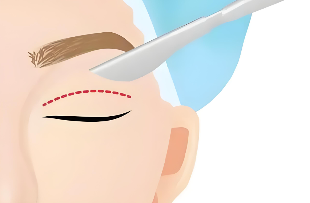 上海卢玲医生双眼皮真实用户反馈：为什么满意度达95%