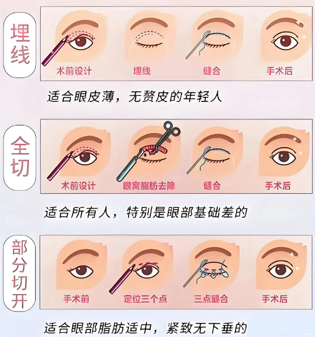 上海朱迪医生双眼皮项目的核心竞争力