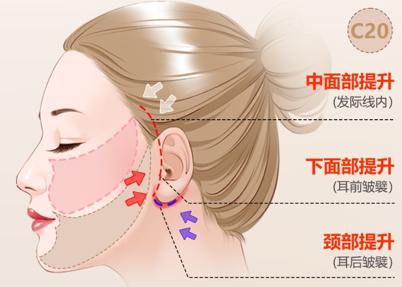 杨大平医生拉皮手术怎么预约？北京联合丽格官网/电话/APP可约，双矢量SMAS技术3万起