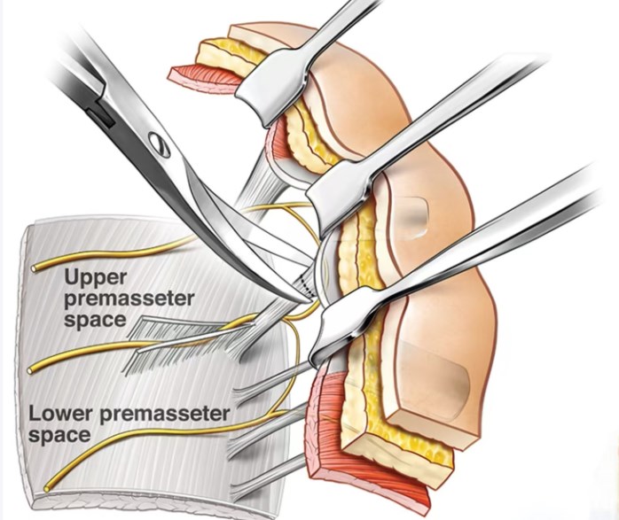高亚东拉皮属于什么档次?中高端梯队!双平面+内窥镜技术,小拉皮3.7万起/大拉皮8万起